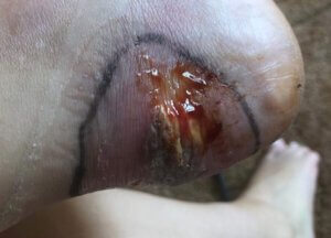 The ugly badly infected blister